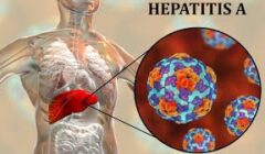 hep a image